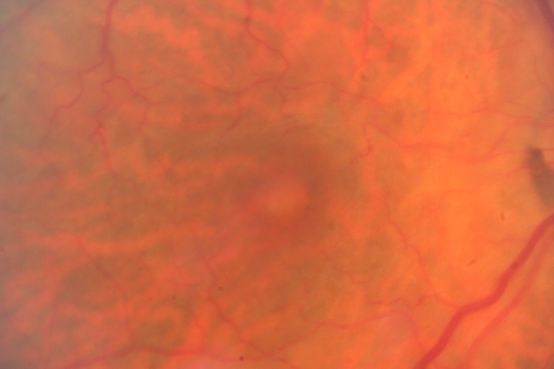 Vitreomacular Traction 1 month - 20/60 vision - Fellow Eye Normal - 80 Year Old Man 
80-year-old man has a macular pucker in the right eye with vitreomacular traction and vision loss for 1 month.  His vision seems about stable to him.   OD 20/60.
(these images are from initial presentation)
