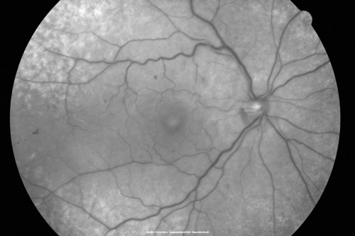 Vitreomacular Traction 1 month - 20/60 vision - Fellow Eye Normal - 80 Year Old Man 
80-year-old man has a macular pucker in the right eye with vitreomacular traction and vision loss for 1 month.  His vision seems about stable to him.   OD 20/60.
(these images are from initial presentation)
