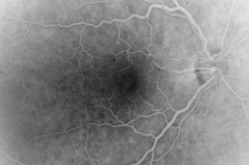 Vitreomacular Traction 1 month - 20/60 vision - Fellow Eye Normal - 80 Year Old Man 
80-year-old man has a macular pucker in the right eye with vitreomacular traction and vision loss for 1 month.  His vision seems about stable to him.   OD 20/60.
(these images are from initial presentation)
