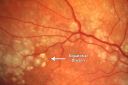 cuticularequatorialdrusen02.jpg