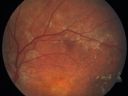 cuticularequatorialdrusen10.jpg