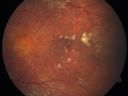 cuticularequatorialdrusen12.jpg