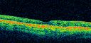 cuticularequatorialdrusen14.jpg