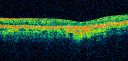 cuticularequatorialdrusen15.jpg