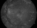 cuticularequatorialdrusen17.jpg