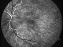 cuticularequatorialdrusen18.jpg