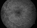 cuticularequatorialdrusen19.jpg