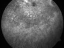 cuticularequatorialdrusen25.jpg