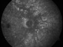 cuticularequatorialdrusen32.jpg
