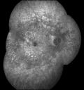 cuticularequatorialdrusen33.jpg