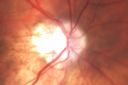 opticatrophy_bawi19.jpg