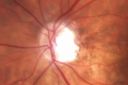 opticatrophy_bawi20.jpg