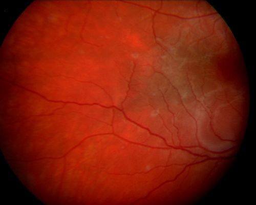 Acute Annular Outer Retinopathy  - VA loss 2 days Right Eye Only - 25 Year Old Woman
Initial visit (June 11, 2011): 2 days of vision loss right eye.  Wedge suddenly of VA loss OD, too dardkto see through.  No flashes or floaters.  VA 20/20 OU.


Keywords: MEWDS;AZOOR;white dot;acute;zonal;occult