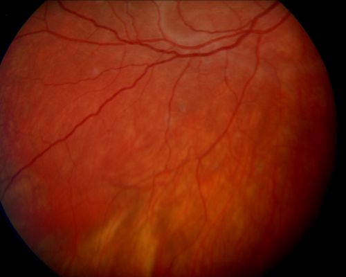 Acute Annular Outer Retinopathy  - VA loss 2 days Right Eye Only - 25 Year Old Woman
Initial visit (June 11, 2011): 2 days of vision loss right eye.  Wedge suddenly of VA loss OD, too dardkto see through.  No flashes or floaters.  VA 20/20 OU.


Schlüsselwörter: MEWDS;AZOOR;white dot;acute;zonal;occult