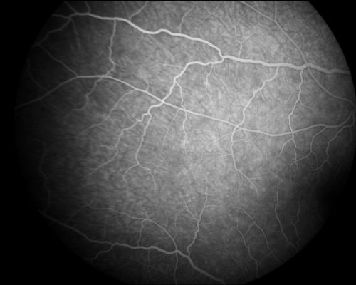 Acute Annular Outer Retinopathy  - VA loss 2 days Right Eye Only - 25 Year Old Woman
Initial visit (June 11, 2011): 2 days of vision loss right eye.  Wedge suddenly of VA loss OD, too dardkto see through.  No flashes or floaters.  VA 20/20 OU.


Schlüsselwörter: MEWDS;AZOOR;white dot;acute;zonal;occult
