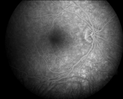 Acute Annular Outer Retinopathy  - VA loss 2 days Right Eye Only - 25 Year Old Woman
Initial visit (June 11, 2011): 2 days of vision loss right eye.  Wedge suddenly of VA loss OD, too dardkto see through.  No flashes or floaters.  VA 20/20 OU.


Keywords: MEWDS;AZOOR;white dot;acute;zonal;occult