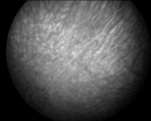 Acute Annular Outer Retinopathy - VA loss 2 days Right Eye Only - 25 Year Old Woman
Initial visit (June 11, 2011): 2 days of vision loss right eye.  Wedge suddenly of VA loss OD, too dardkto see through.  No flashes or floaters.  VA 20/20 OU.


Keywords: MEWDS;AZOOR;white dot;acute;zonal;occult