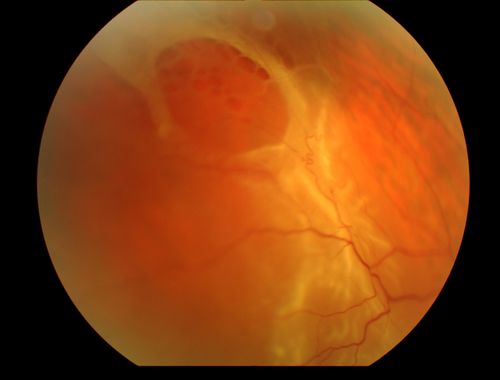 Combined schisis-rhegmatogenous RD
Multiple outer layer and inner layer holes
Keywords: rhegmatogenous retinal detachment, degenerative retinoschisis;july2012