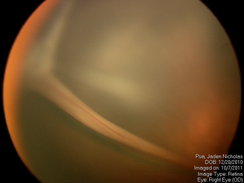 PHPV - right eye. Peripheral extension 
