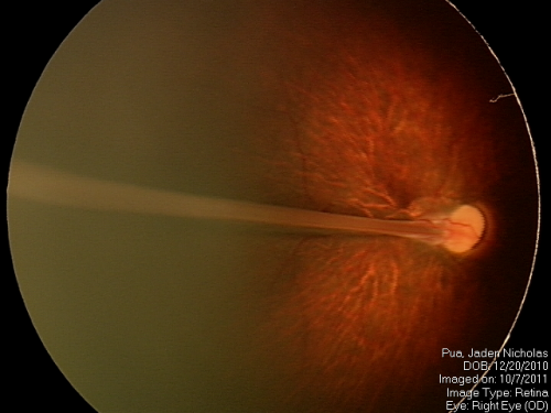 PHPV - right eye - optic nerve

