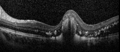Coats' Disease in 14 Year Old Boy Treated with Cryotherapy and Avastin
14 Year Old Boy with Coats Disease
