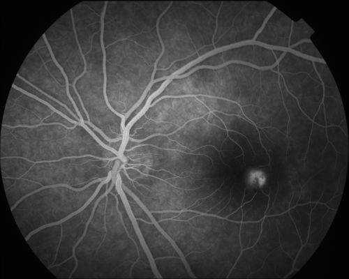 Coats' Disease in 14 Year Old Boy Treated with Cryotherapy and Avastin
14 Year Old Boy with Coats Disease
