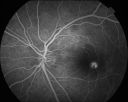 Fig__3A_FA_pre_macula.jpg