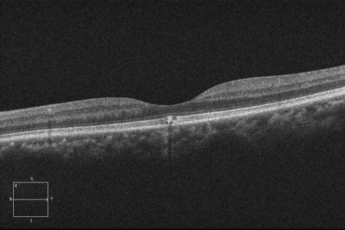 Solar retinopathy
A 27 year old African American male presented with a complaint of poor vision in both eyes for several months. 

PMH: none
Medications: none
BCVA 20/40 OU
Slit-lamp exam: normal OU

On further questioning, he enjoys staring at the sun for 3-4 hours each day.
Keywords: solar