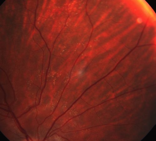 Benign retinal flecks
Asymptomatic, well nourished 16 yo presents with unilateral retinal flecks
