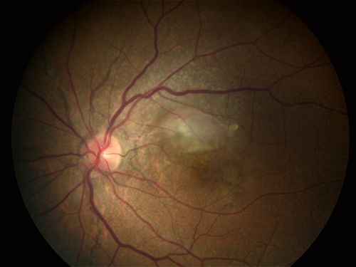 CNV secondary to Angioid Streaks, PXE
Keywords: Angioid Streaks, PXE, CNV