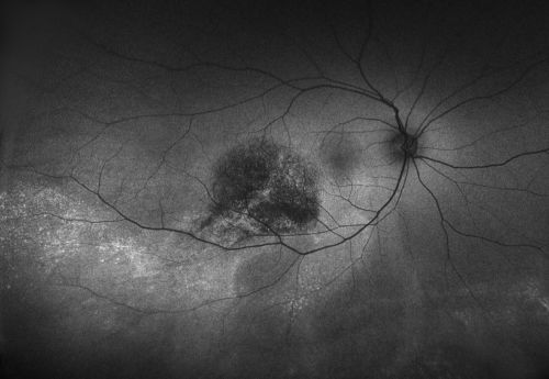 Choroidal Hemangioma
