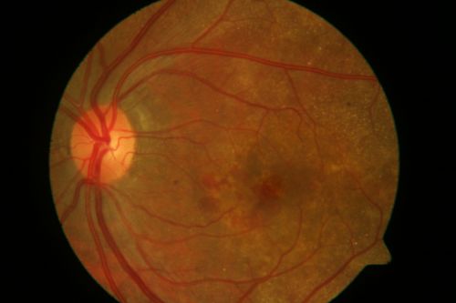 Best Vettiliform Dystrophy with CNVM-4
