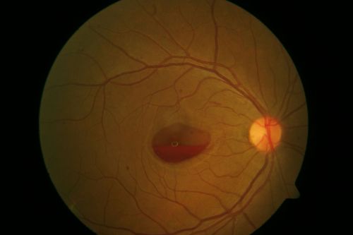 A case of Valsalva Retinopathy -3
