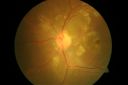 Disc_granuloma3.jpg