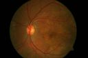 bettili_dystrophy_with_CNVMa.jpg