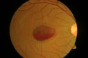 valsalva_retinopathy1.jpg