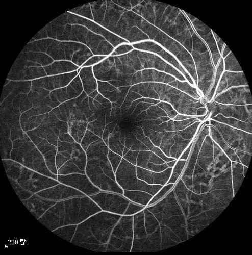 Ophthalmomyiasis interna
Ophthalmomyiasis interna

track of Ophthalmomyiasis like linear

rarely image
Keywords: june2012