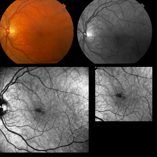 Acute Macula Neuroretinopathy
39yr old male: Presents with Inferior Temporal Scotoma in his left eye, x 10 days with no change in shape or size, Visual acuity 20/25. 
Most common sysptoms are described as sudden onset of one or more paracentral scotomas.  {with the tip pointing toward the Fovea} without any other visual symptoms. Currently no treatment recommended.
Keywords: Scotoma, Macula, Neuroretinopathy;jan2012