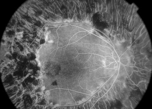 early phase FA
50+ YO female presented with DM type 1;
PT presented with PDR s/p extensive PRP
FA showed CNV OD
VA stable at 20/150 for 1 year

Keywords: cnvm;cystoid macular edema;Diabetic;diabetic like;laser