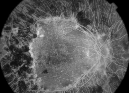 early phase FA
50+ YO female presented with DM type 1;
PT presented with PDR s/p extensive PRP
FA showed CNV OD
VA stable at 20/150 for 1 year

Võtmesõnad: cnvm;cystoid macular edema;Diabetic;diabetic like;laser