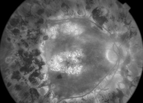late phase FA
50+ YO female presented with DM type 1;
PT presented with PDR s/p extensive PRP
FA showed CNV OD
VA stable at 20/150 for 1 year

Keywords: cnvm;cystoid macular edema;Diabetic;diabetic like;laser;september2013