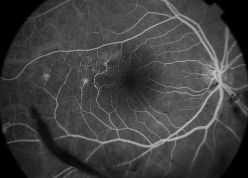 Aplastic anemia
29 y.o.m. with aplastic anemia OD VA 20/25. 
Keywords: Aplastic anemia;feb2012