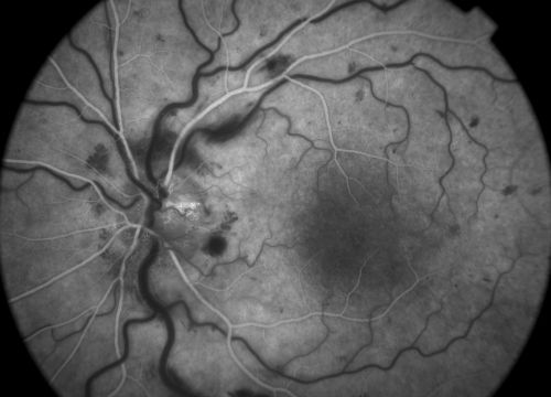 early phase (20 sec) fa of a 27 year old male with crvo os VA 20/20
Keywords: crvo