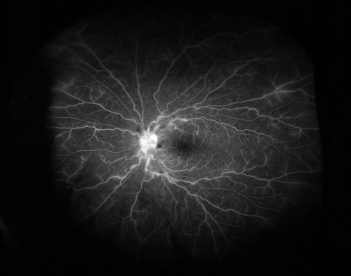 CVO
late FA (5min) optos photo of a 27 year old male with crvo os VA 20/20-
Schlüsselwörter: crvo