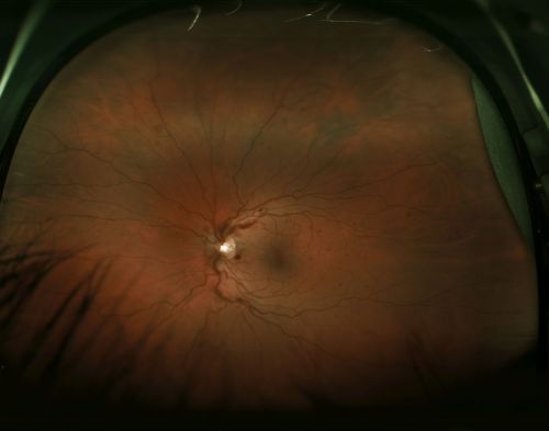 CVO
optos photo of a 27 year old male with crvo os VA 20/20-
Keywords: crvo