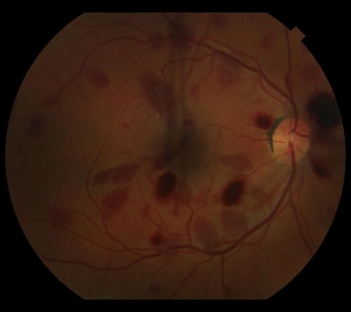 CRVO (retinal thrombophlebitis)
42 yr old female
20/25 VA
Labs normal
