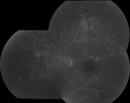 Diabetic Macular Edema
63 yr old Male
VA 20/20 OD 20/25 OS
No complaints

Keywords: jan2011