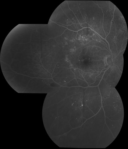 Diabetic Macular Edema
63 yr old Male
VA 20/20 OD 20/25 OS
No complaints

