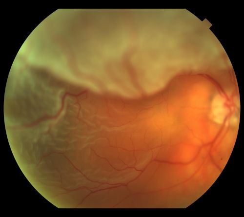 Retinal Detachment
80 yr old Male
Wet AMD c/o sudden loss of VA
Keywords: jan2011