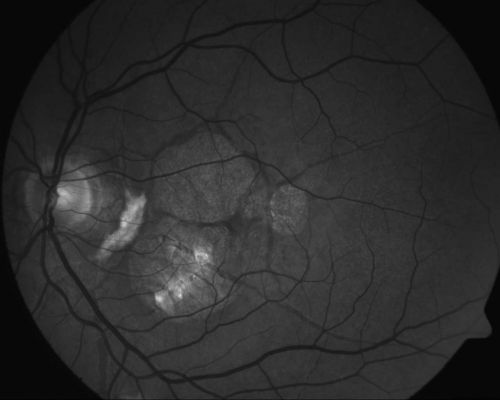 Angioid Streaks and Treated CNVM
Maculopathy associated to angioid streaks in a 45 years old patient, man, 
treated for related CNV

Keywords: feb2012